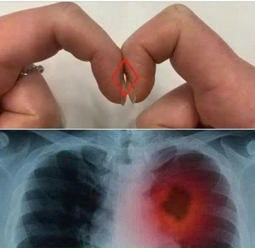 Đặt 2 đầu ngón tay trỏ sát nhau để biết mình bị ung thư phổi không: Cách thử nhanh BS cũng công nhận